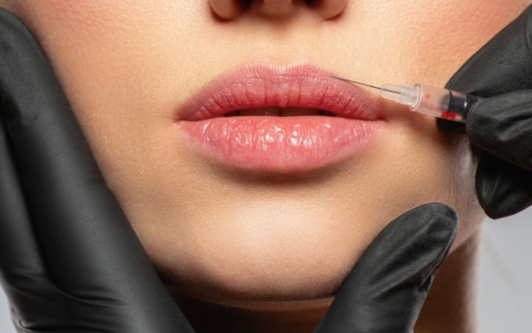 Embellir ses lèvres par injections d’Acide Hyaluronique à Montpellier