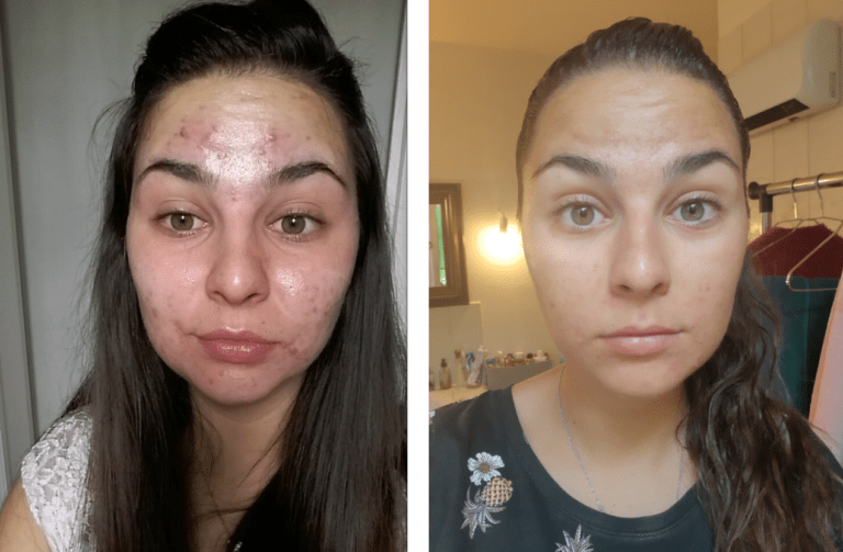traitement acné Montpellier