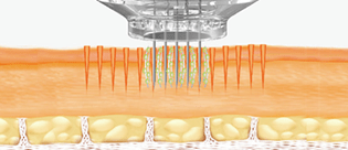 Microneedling EPN 