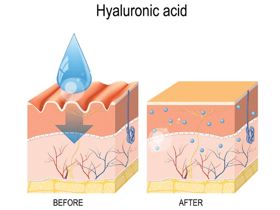 Acide hyaluronique rides