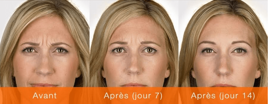 Botox Avant Après