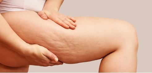 Cellulite Aqueuse