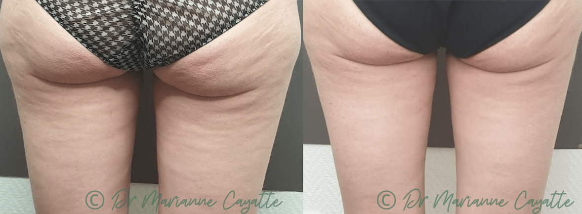 traitement cellulite montpellier