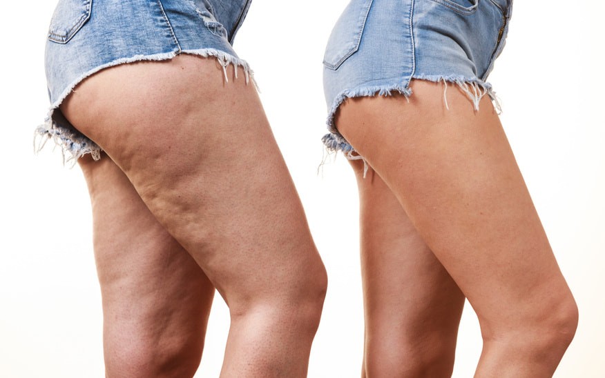 Cellulite adipeuse